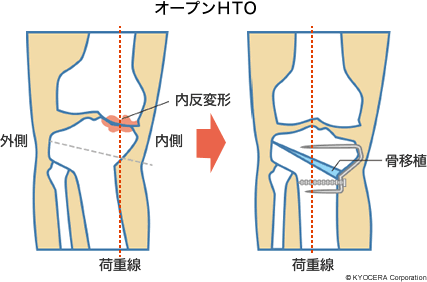 オープンHTO