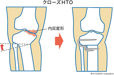 クローズHTO