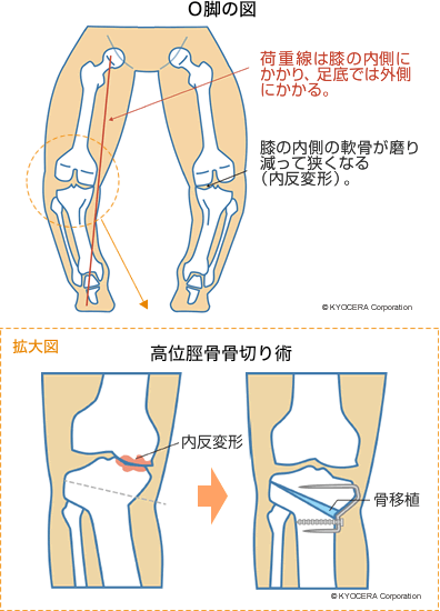 O脚の図 高位脛骨骨切り術