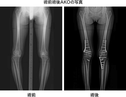 術前術後AKOの写真