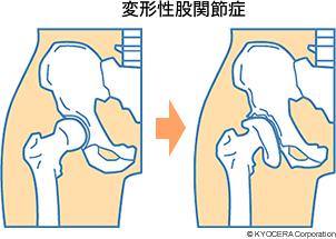 変形性股関節症