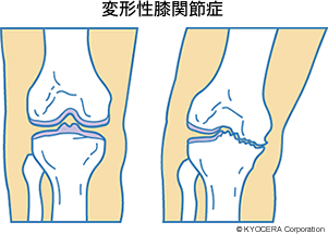 変形性膝関節症