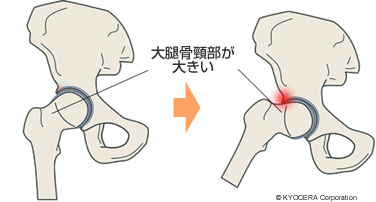 FAIの原因 大腿骨頸部が大きい