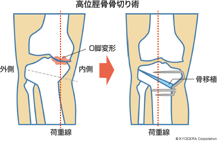 高位脛骨骨切り術