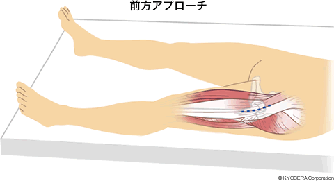 前方アプローチ