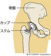 人工股関節イラスト