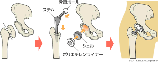 人工股関節の例