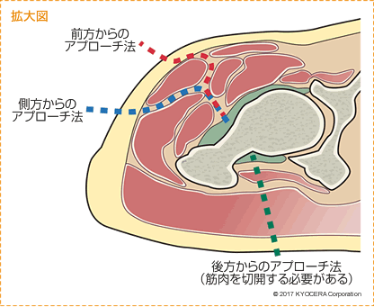 前方からのアプローチ法 拡大図