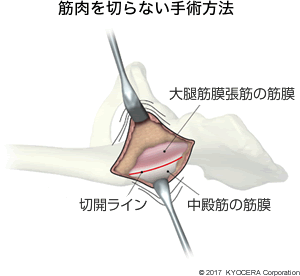 筋肉を切らない手術方法