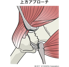 上方アプローチ