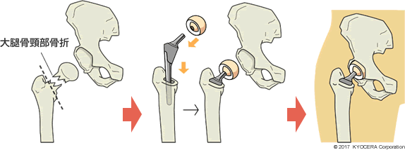 人工骨頭置換術の例