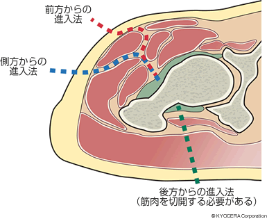 前方からの進入法 側方からの進入法 後方からの進入法