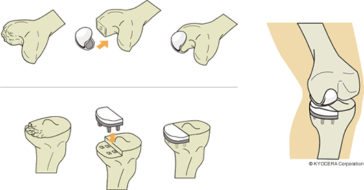 人工膝関節単顆置換術