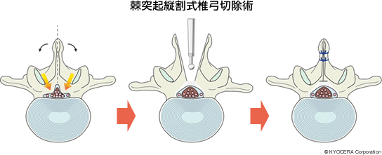 棘突起縦割式椎弓切除術