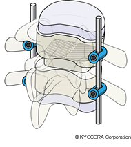 椎体間固定術