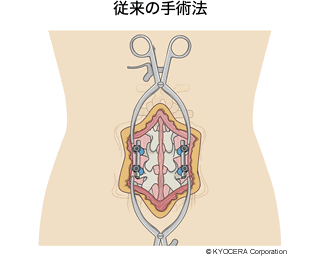 従来の手術法