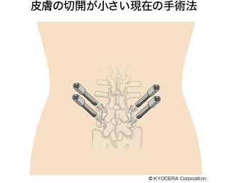 皮膚の切開が小さい現在の手術法