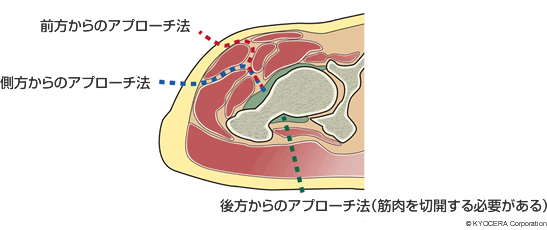 前方からのアプローチ法、側方からのアプローチ法、後方からのアプローチ法（筋肉を切開する必要がある）