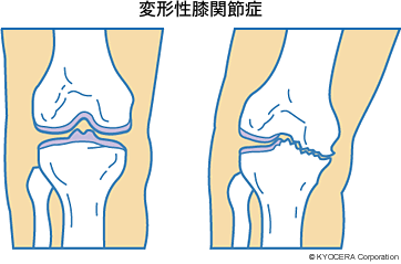 変形性膝関節症