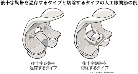 後十字靭帯を温存するタイプと切除するタイプの人工膝関節の例