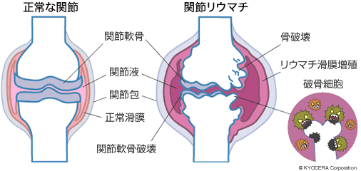 正常な関節と関節リウマチ