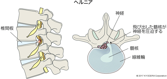 ヘルニア