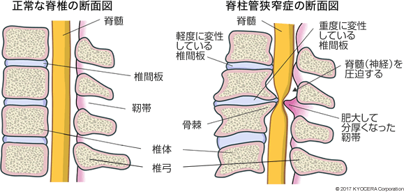 正常な脊椎の断面図 脊柱管狭窄症の断面図