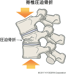 脊椎圧迫骨折