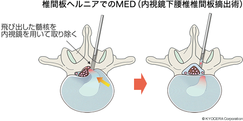 椎間板ヘルニアでのMED（内視鏡下腰椎椎間板摘出術）