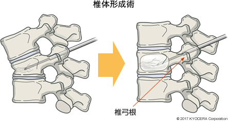 椎体形成術