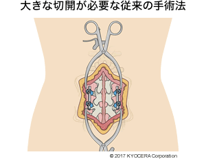 大きな切開が必要な従来の手術法