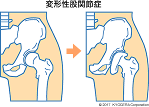 変形性股関節症