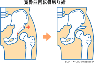 寛骨臼回転骨切り術