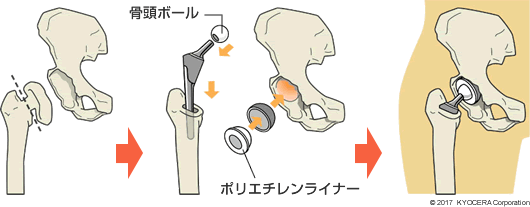 人工股関節置換術の例