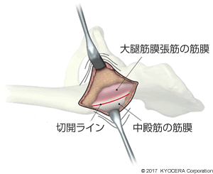 人工股関節置換術