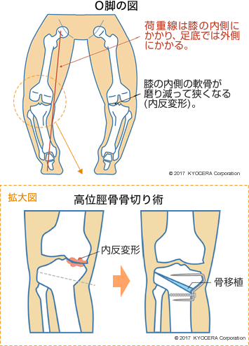 O脚の図 高位脛骨骨切り術