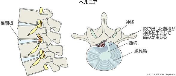 ヘルニア