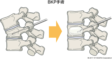 BKP手術