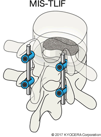 MIS-TLIF