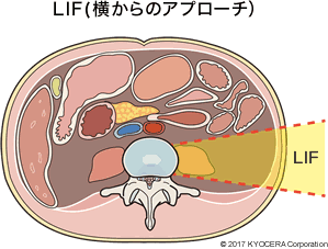 LIF(横からのアプローチ）