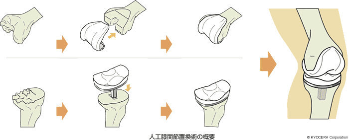 人工膝関節置換術の概要