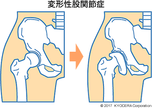 変形性股関節症