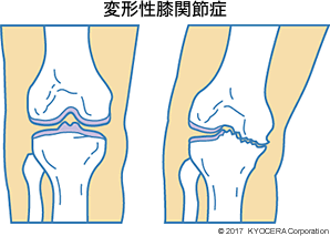 変形性膝関節症