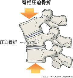 脊椎圧迫骨折