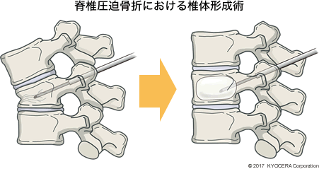 脊椎圧迫骨折における椎体形成術