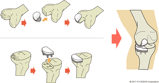 人工膝関節単顆置換術