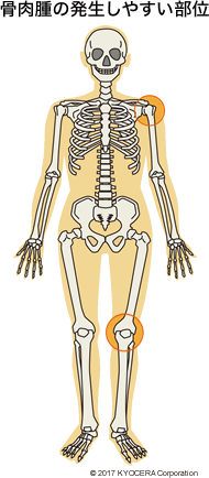 骨肉腫の発生しやすい部位