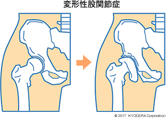 変形性股関節症