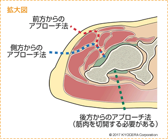 アプローチ法 拡大図