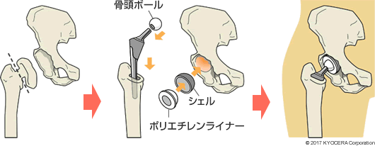 人工股関節置換術の例